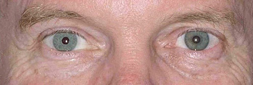artificialiris-customflex-iris-implant-operating-theatre-result-aniridia-patients-satisfaction-humanoptics(2).jpg