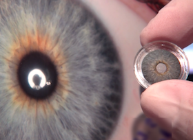Artificial iris from HumanOptics receives FDA approval