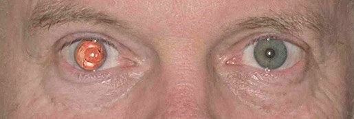 artificialiris-customflex-iris-implant-before-after-aniridia-patients-satisfaction-humanoptics(2).jpg
